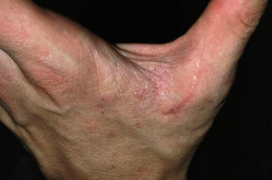 dr. Epifania Fitriana Adna : Kenali Penyakit Scabies dan Cara Pencegahannya